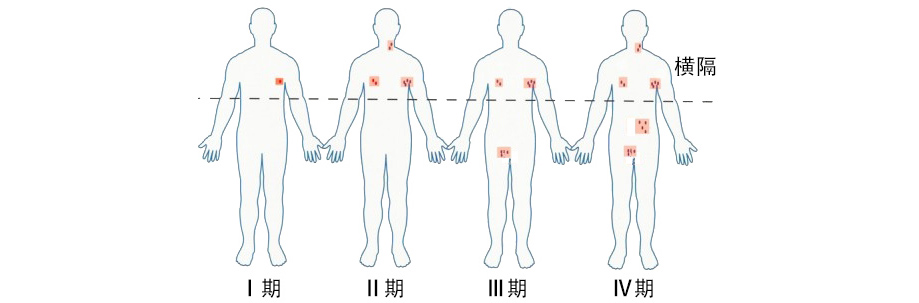 淋巴瘤-04.jpg